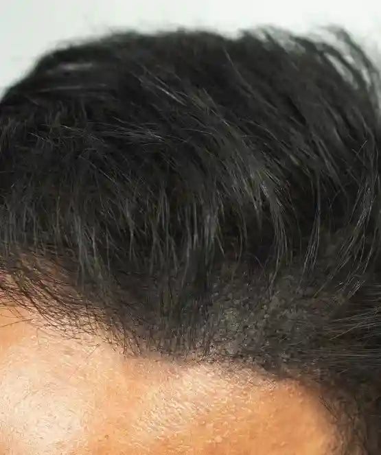 After applying MEENSE hair fibers for a fuller-looking front hairline