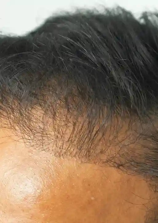 Before using MEENSE hair fibers on a thinning front hairline